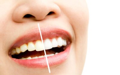 ¿Cómo eliminar las manchas en los dientes de forma efectiva?